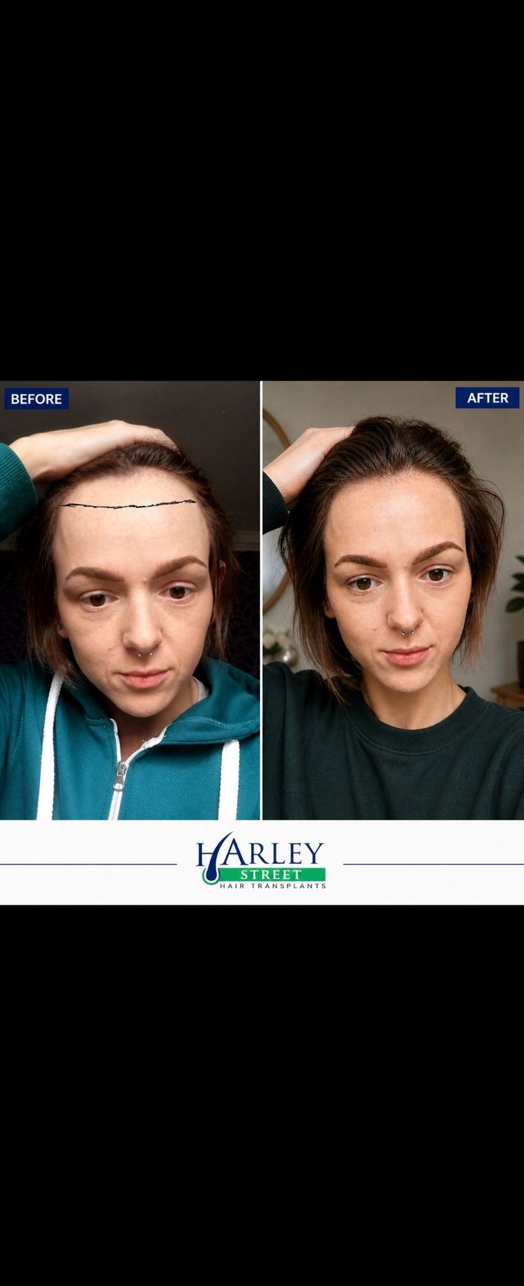 Before and after image of a women's hairline transplant 