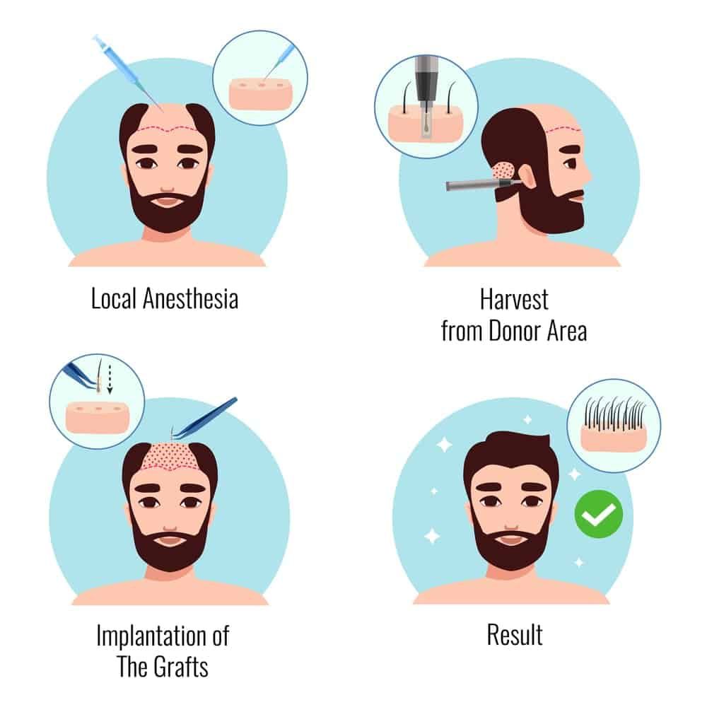 an infographic showing the different stages involved with a hair transplant