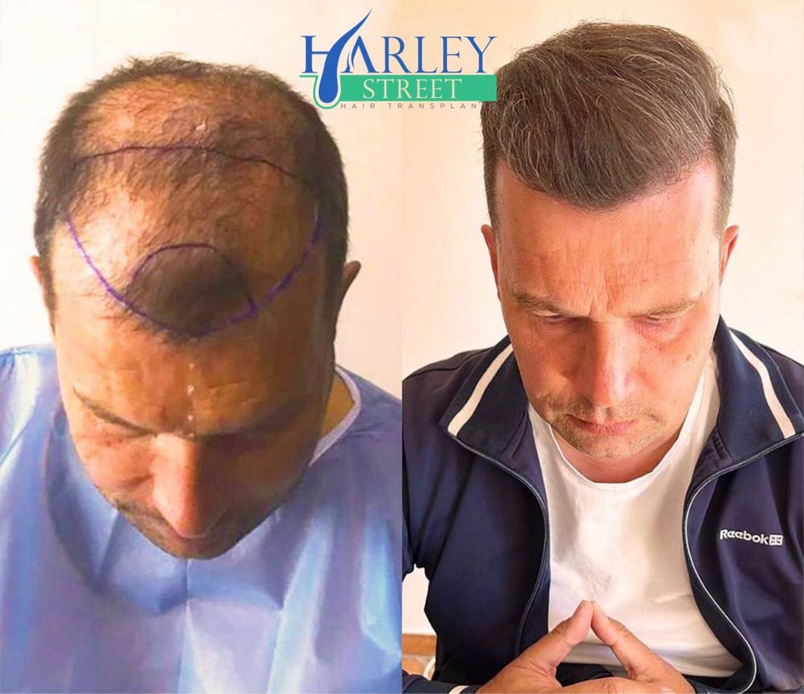 Before and after picture of a man 12 months after having FUE hair transplant 
