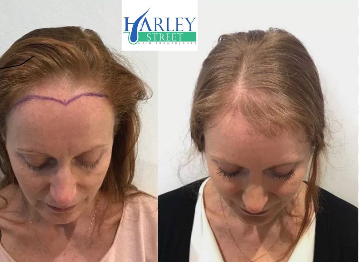 Before and after picture of a woman 12 months after having FUE hair transplant 