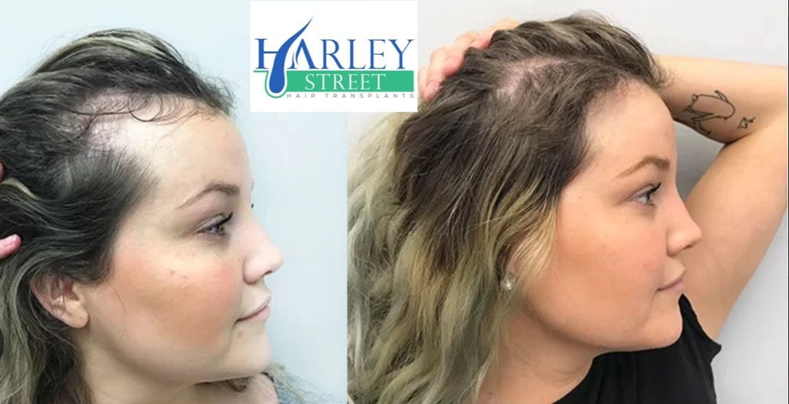 Before and after picture of a woman 12 months after having FUE hair transplant.