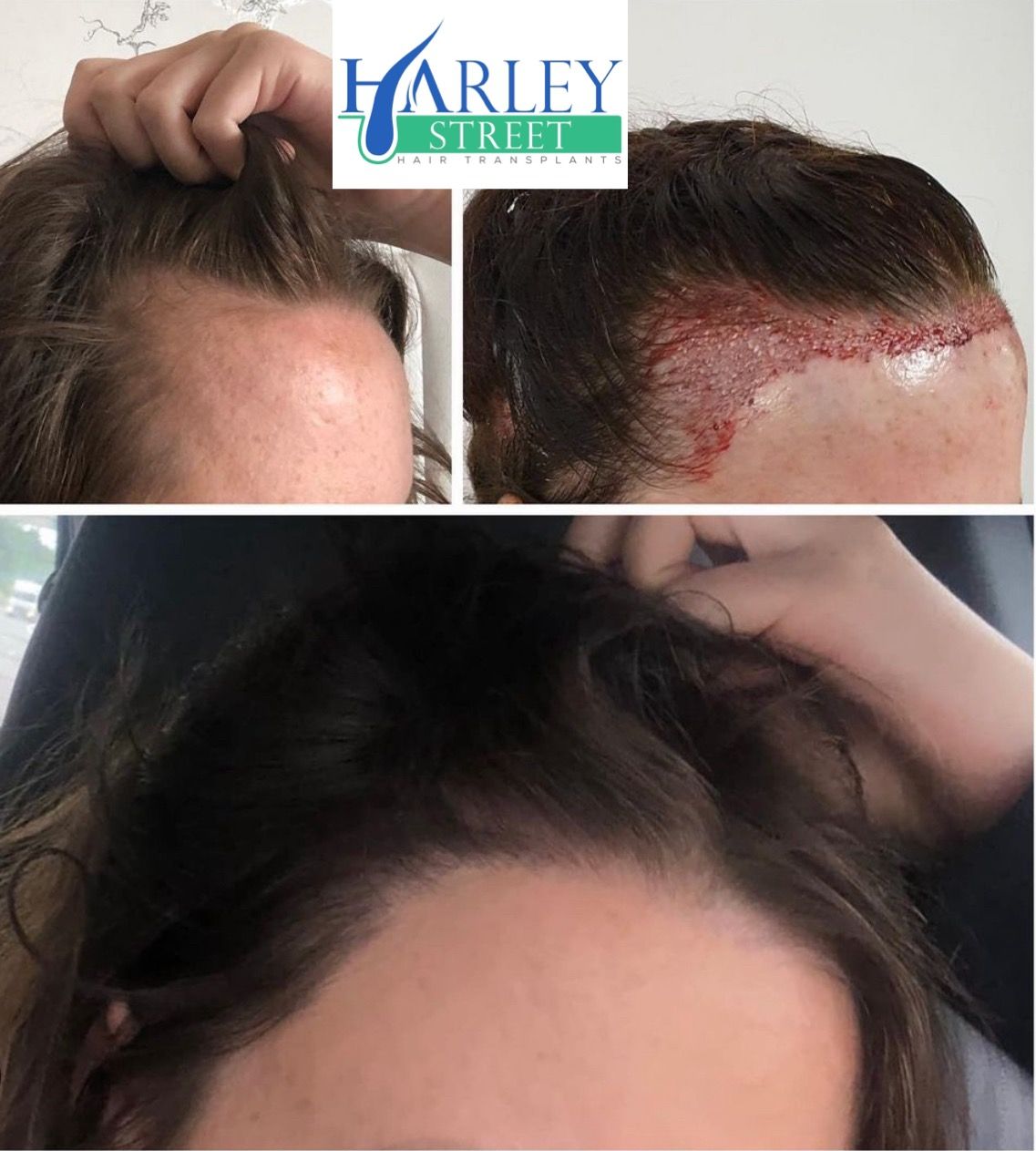 Before and after picture of a woman 12 months after having FUE hair transplant 