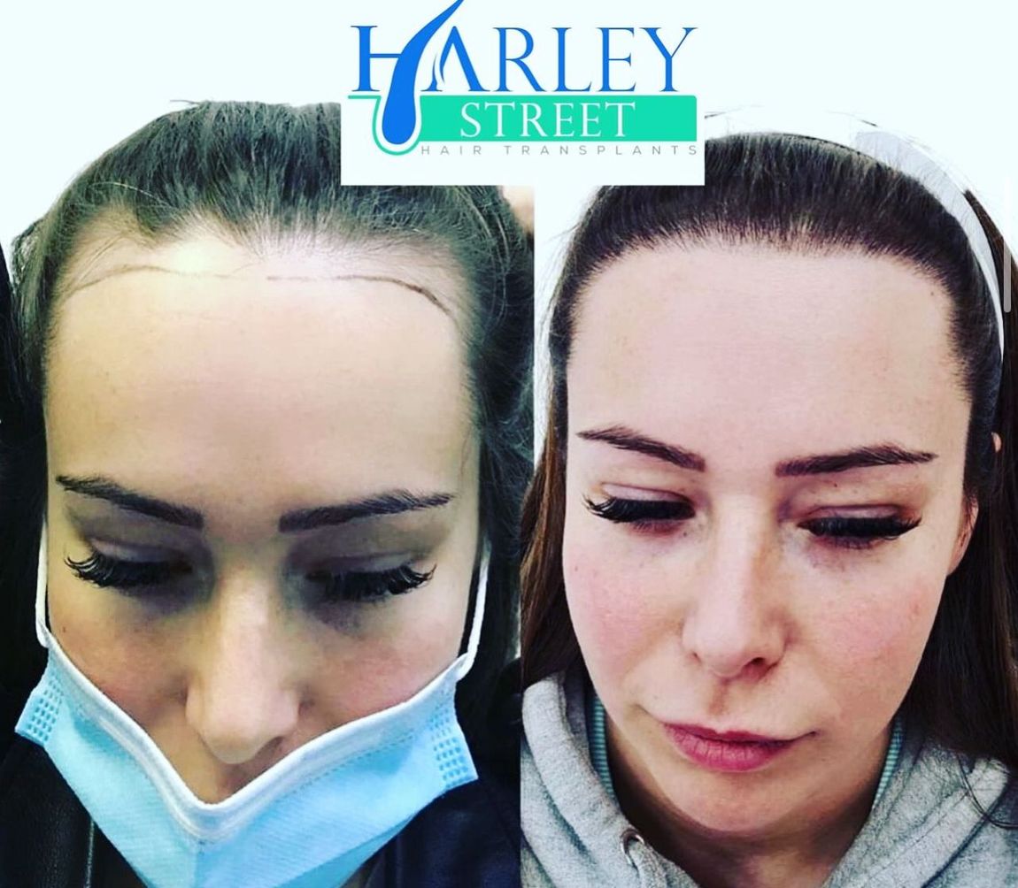 Before and after picture of a woman 12 months after having FUE hair transplant 