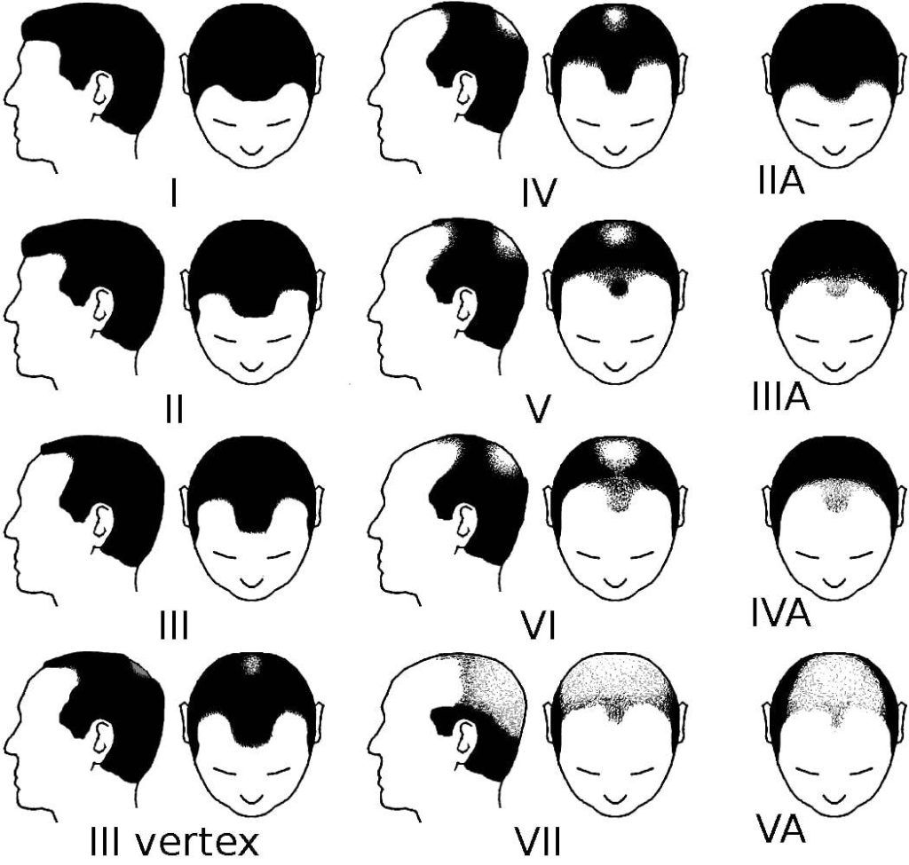 an infographic showing the Norwood-Hamilton Scale for categorising male pattern baldness