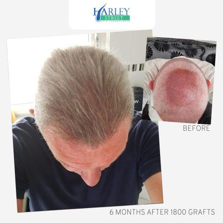 Hair Transplants UK  Hairloss & PRP Clinic Leicester