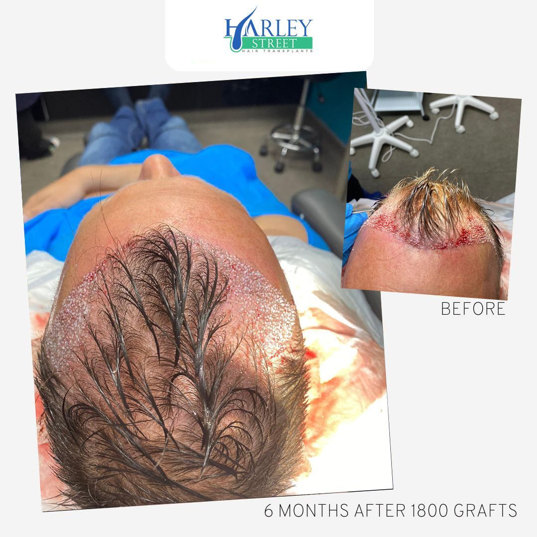 before and after pictures of male and female patients after a hair transplant with Harley Street Hair Transplant London