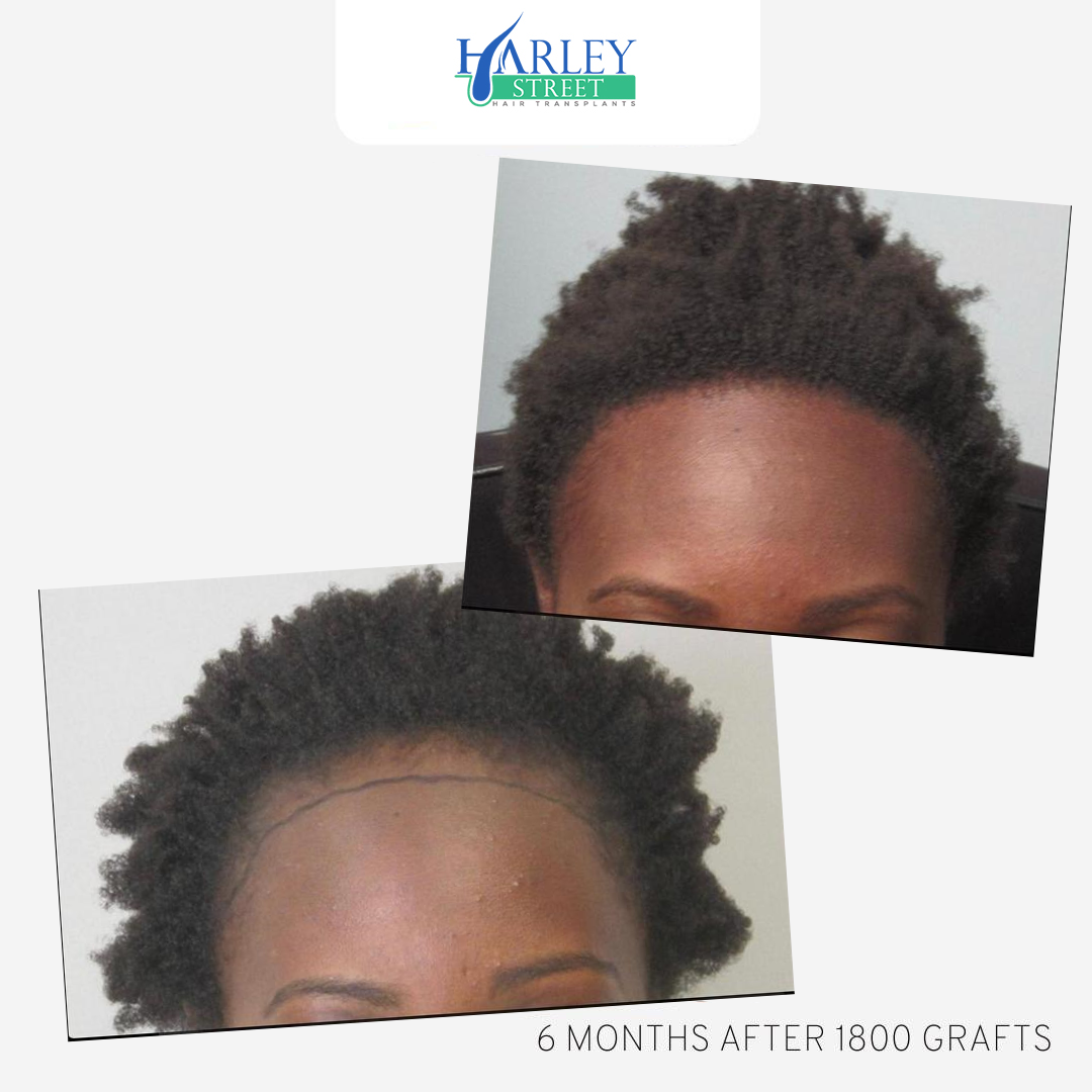 a picture of a black female with afro hair before and after a hair transplant with Harley Street Hair Transplant London