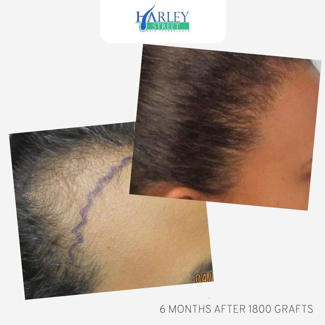 Hair Loss Treatment Options Which One is Right for You?