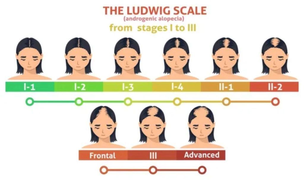 an infographic showing the Ludwig Scale for categorising female pattern baldness