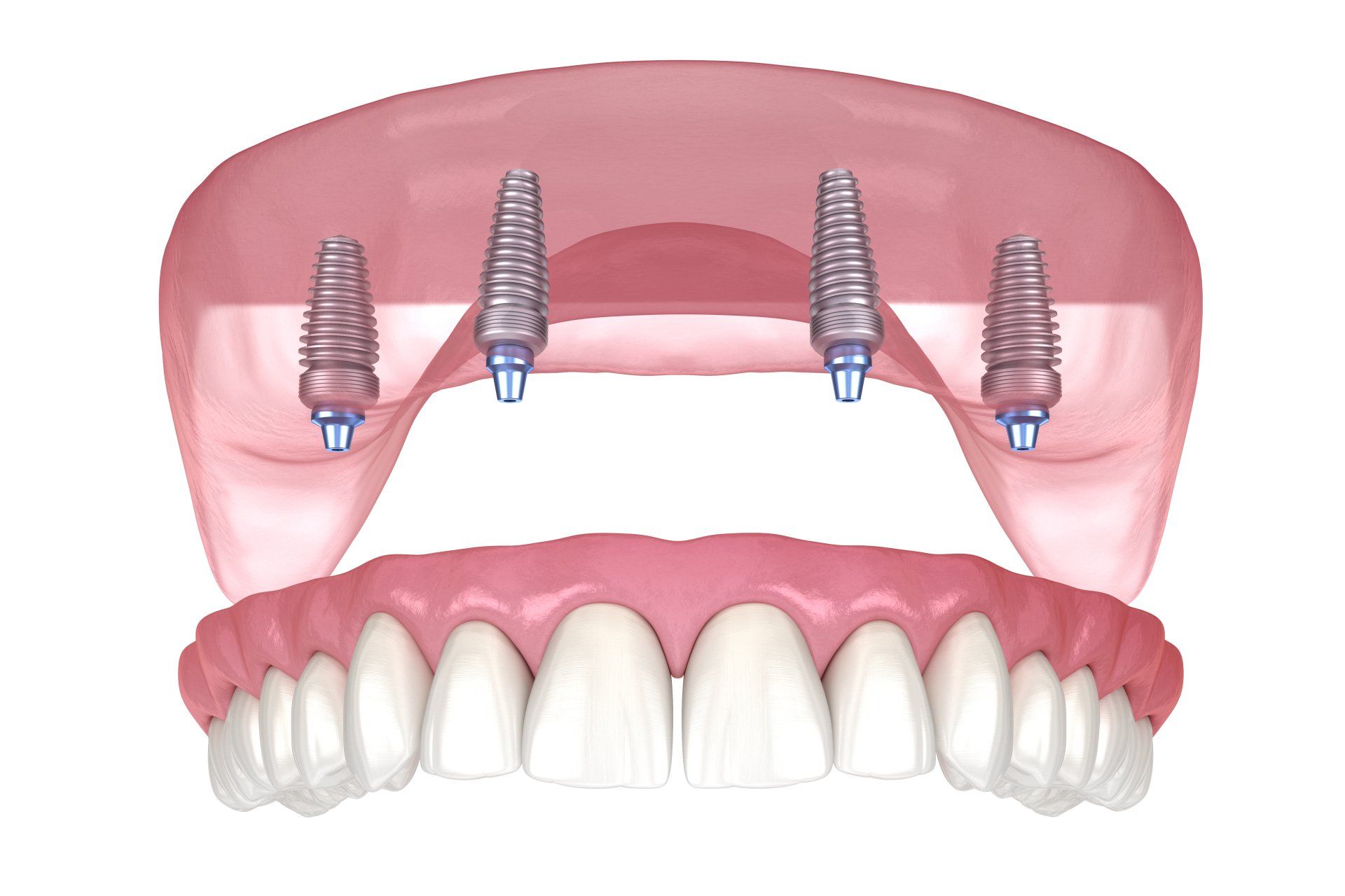 model of permanent dentures on 4 implants