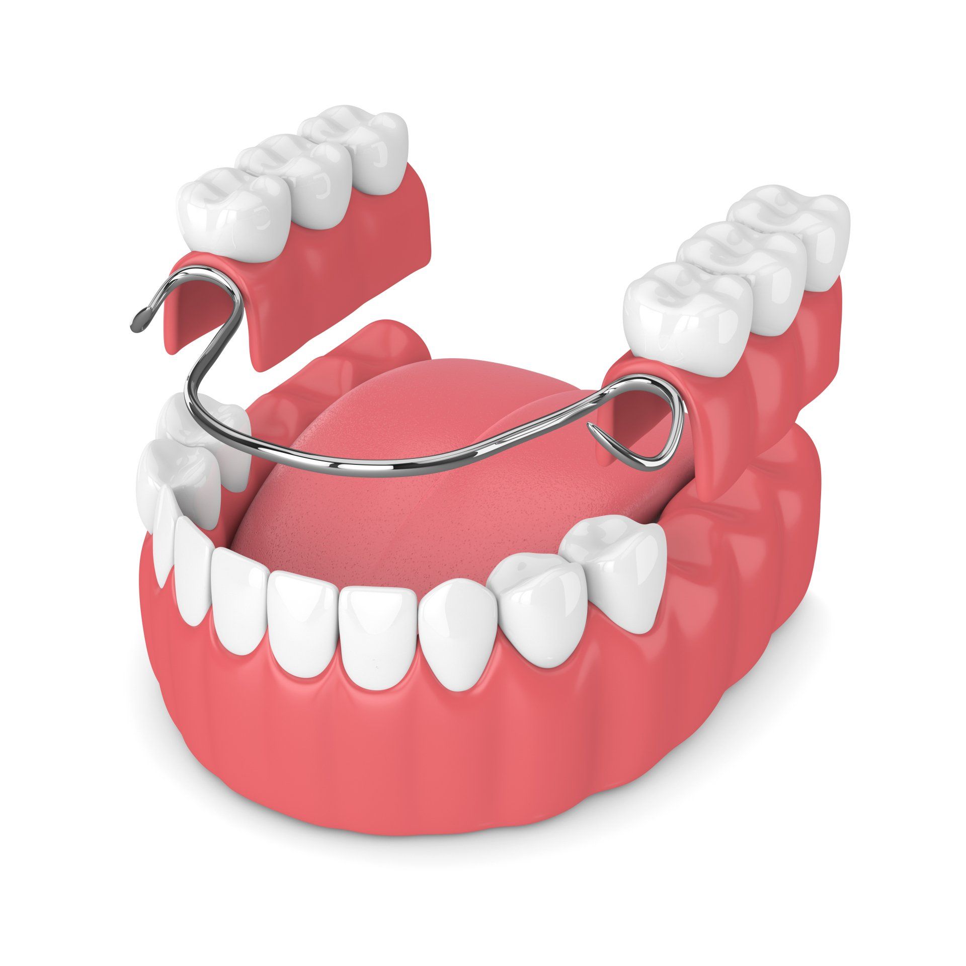 model of partial dentures