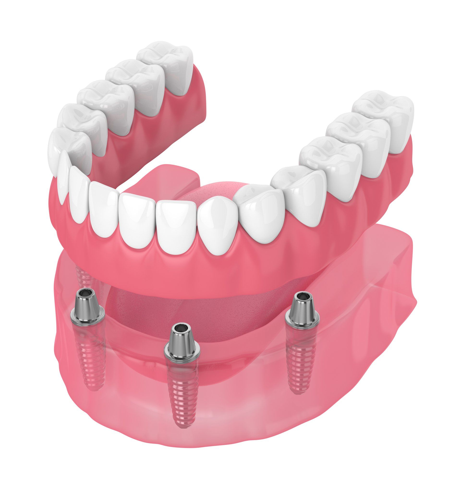 model of snap-on dentures and how they work