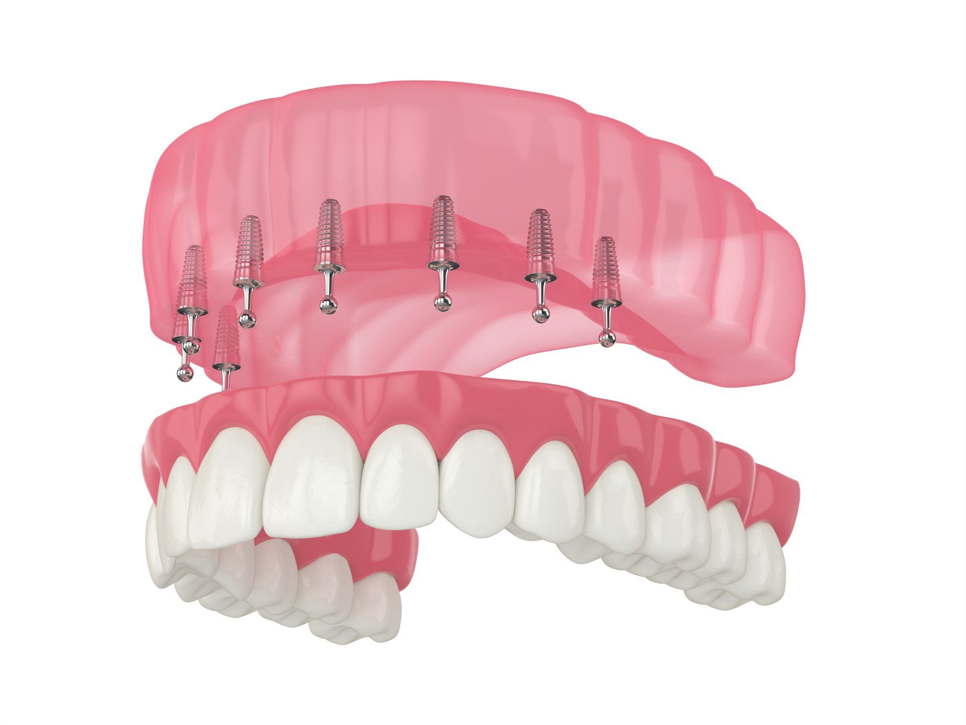 model of permanent dentures on 8 implants