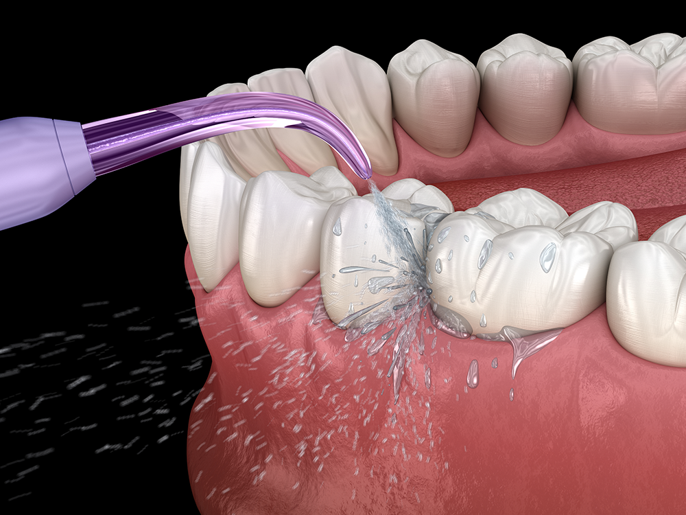 model of teeth and a water flosser to illustrate how to clean implant bridges