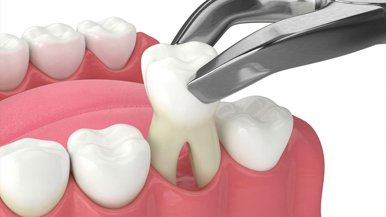 Tooth Removal | Aurora, IL | Prairie Point Dental