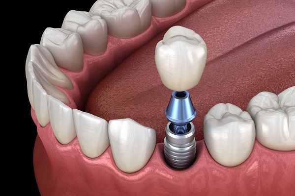 Dental Implants | Aurora, IL | Prairie Point Dental