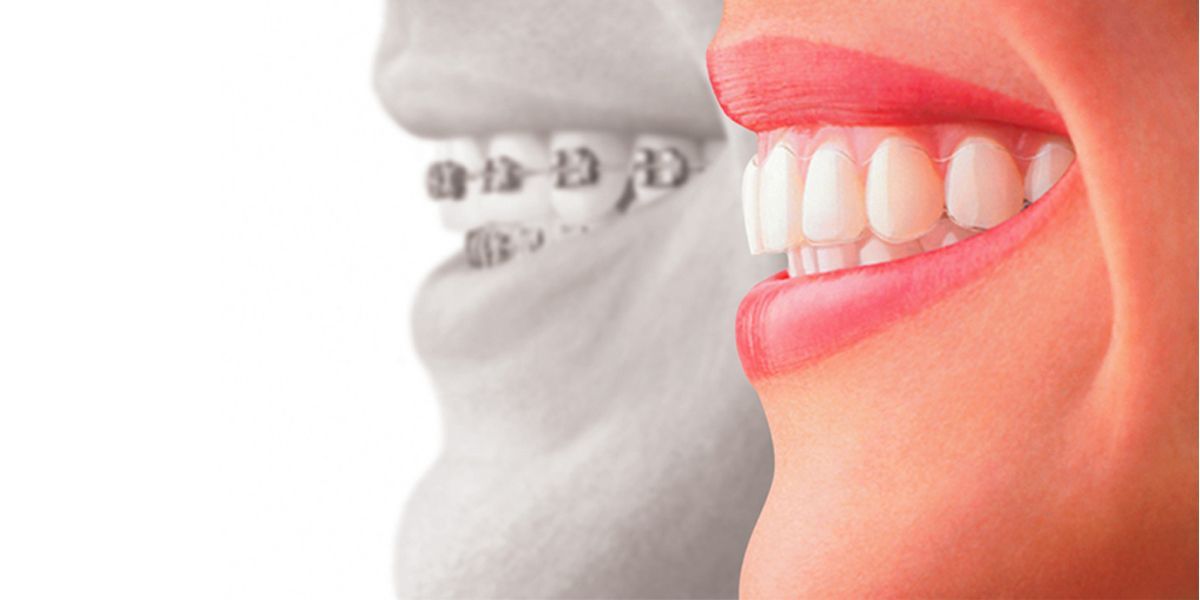 Invisalign | Aurora, IL | Prairie Point Dental