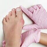 Bunion in Woman Foot — Bunions in Chicago, IL Bunion in Woman Foot — Bunions in Chicago, IL