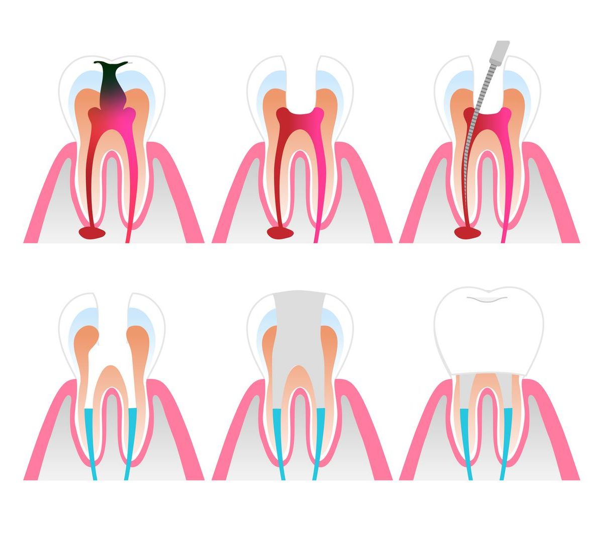 A diagram of a tooth being treated by a dentist