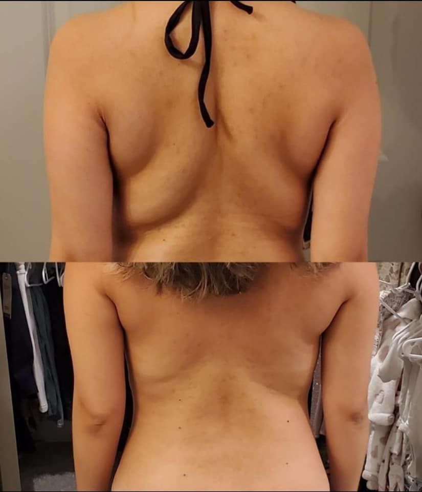 Woman before and after slimming treatment— Spring Park, MN — Skingevity Med Spa