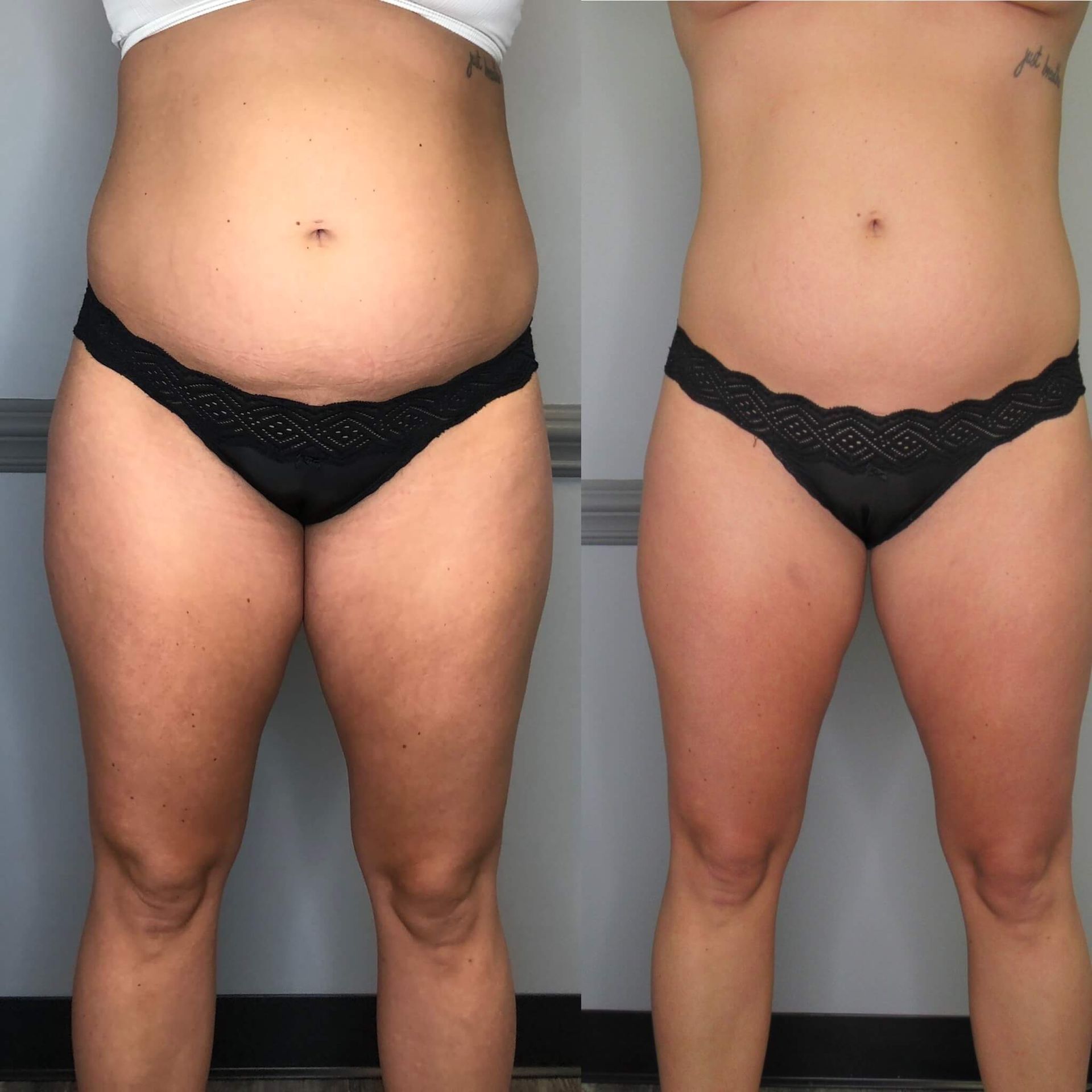 Cryoskin Slimming— Spring Park, MN — Skingevity Med Spa