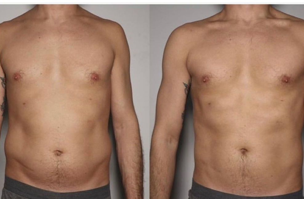 Man Slimming Treatment — Spring Park, MN — Skingevity Med Spa