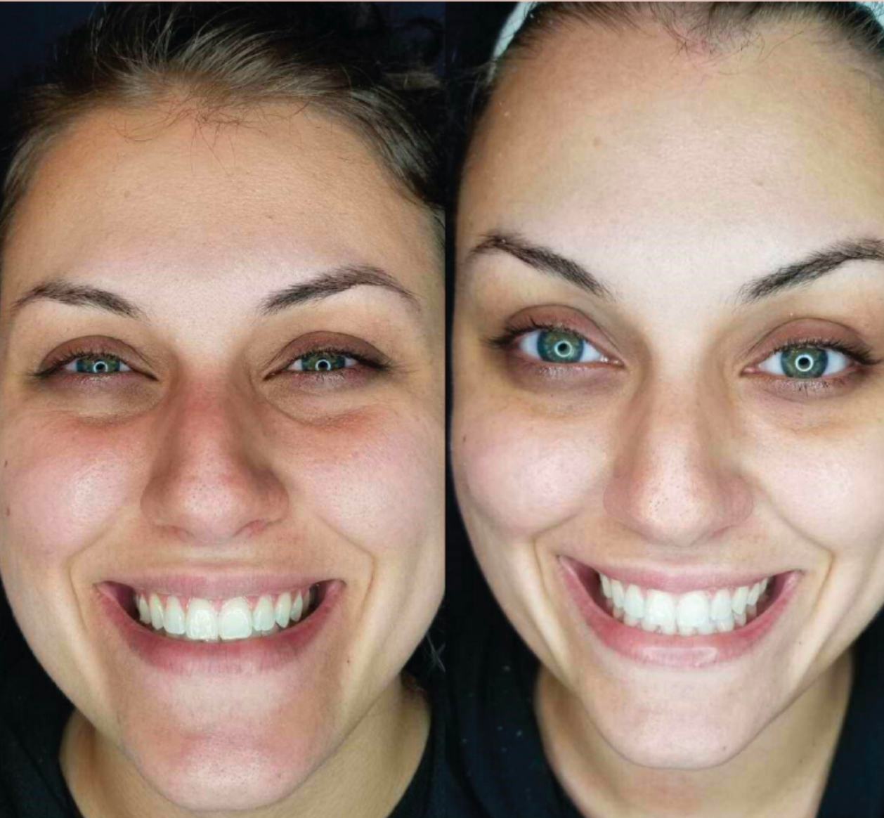 Cryoskin Treatment — Spring Park, MN — Skingevity Med Spa