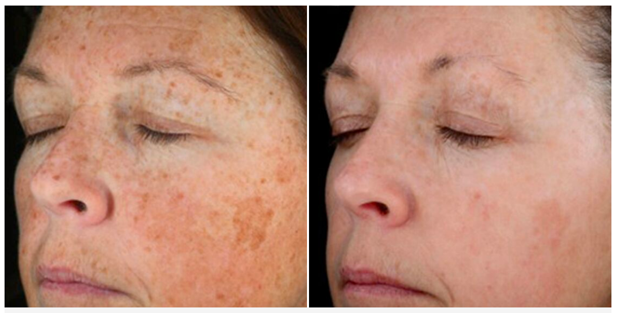 Spot Treatment — Spring Park, MN — Skingevity Med Spa