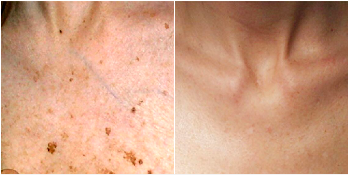 Laser Skin Tightening — Spring Park, MN — Skingevity Med Spa