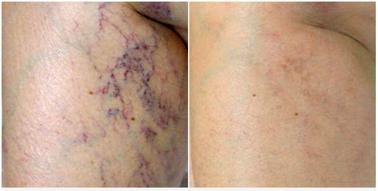 Varicose veins removal — Spring Park, MN — Skingevity Med Spa