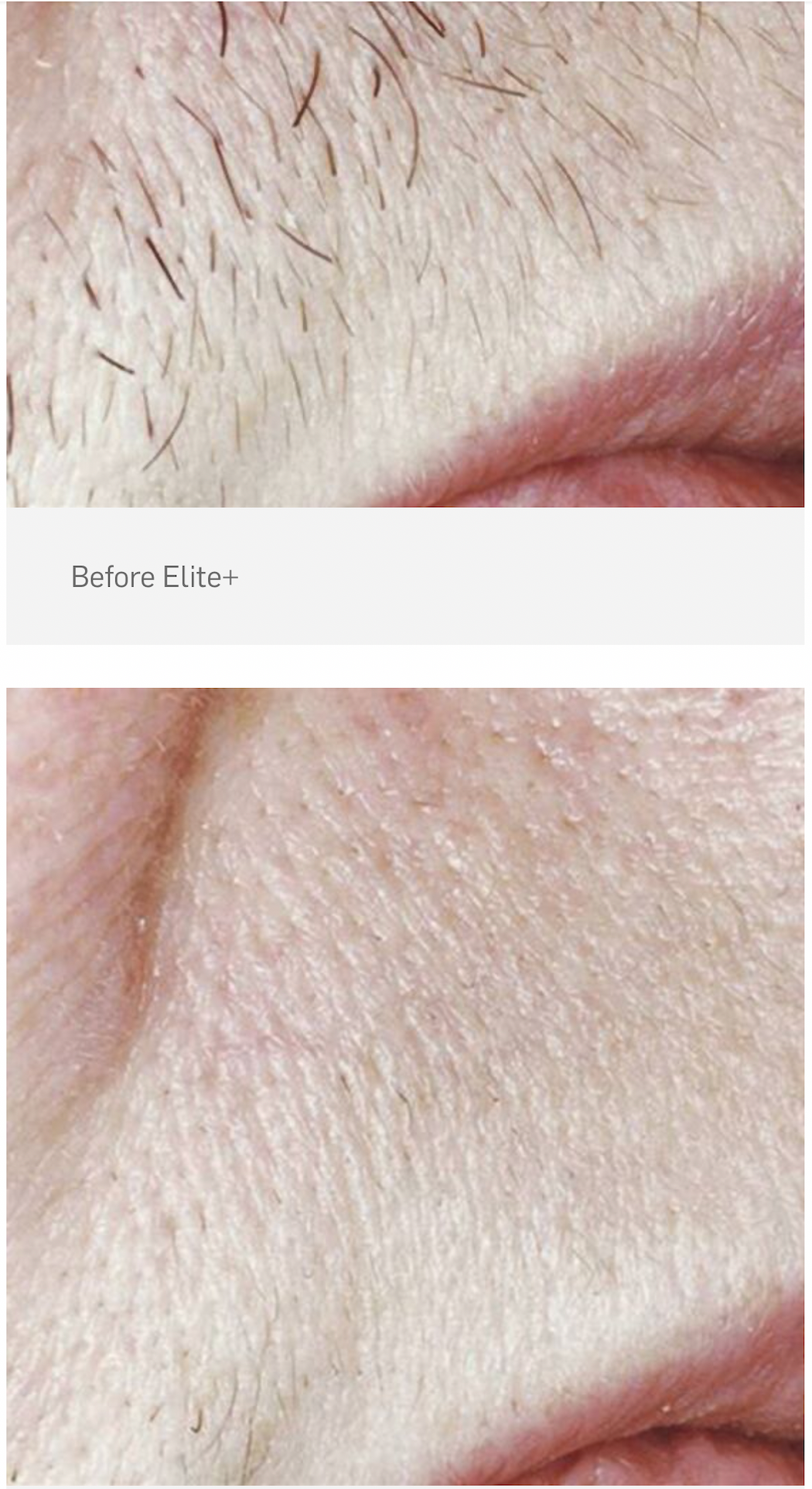 Laser Hair Removal — Spring Park, MN — Skingevity Med Spa