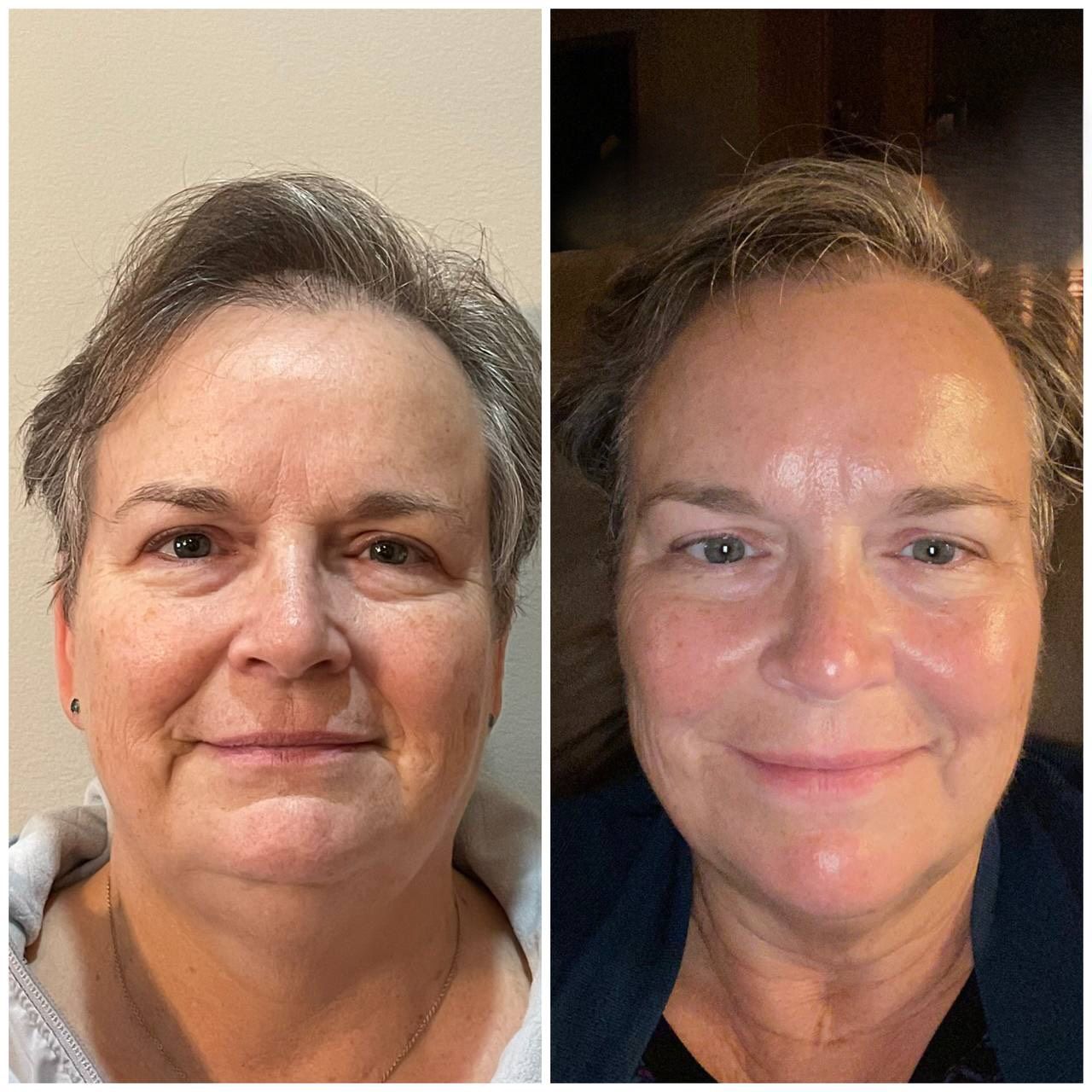 Cryotoning Treatment — Spring Park, MN — Skingevity Med Spa