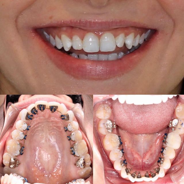 Lingual Braces, Oppenheimer Orthodontics