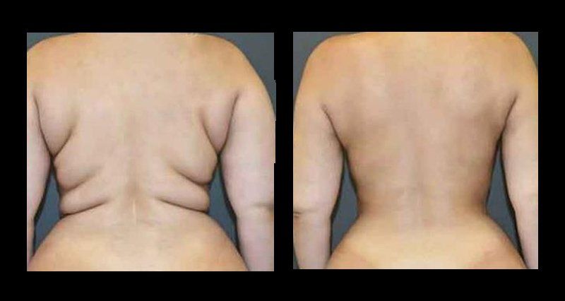 abdominoplasty in mexico
