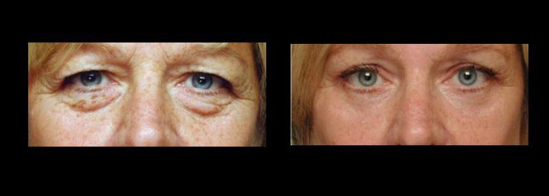 blepharoplasty in mexico