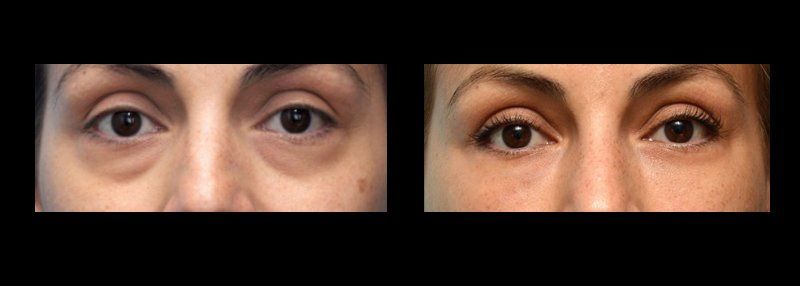 blepharoplasty in mexico