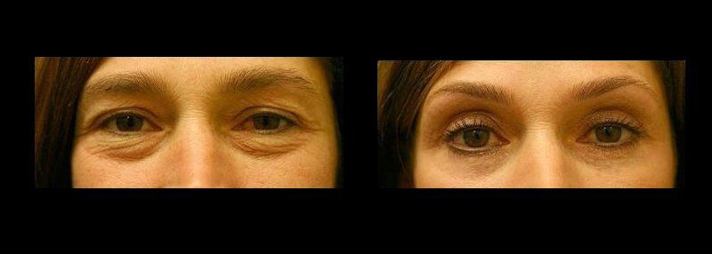 blepharoplasty in mexico