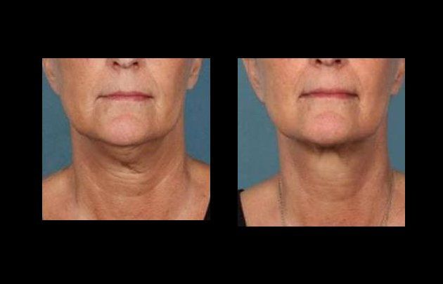 neck and facelift in mexico