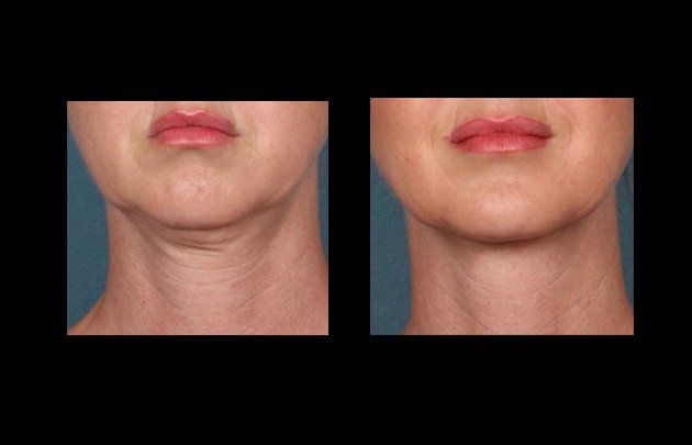 neck and facelift in mexico