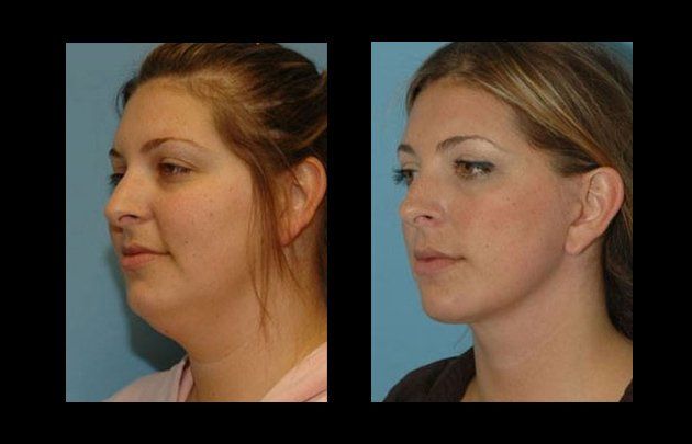 neck and facelift in mexico