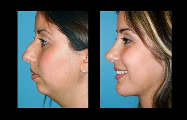 neck and facelift in mexico