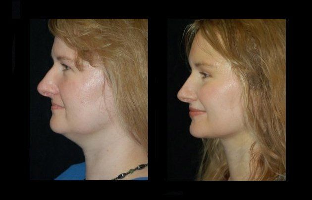 neck and facelift in mexico