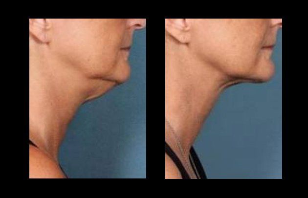neck and facelift in mexico