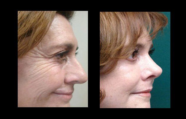 facial rejuventaton in mexico