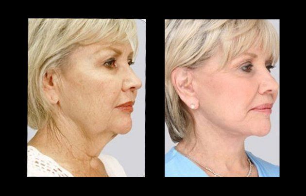 facial rejuvenation in mexico