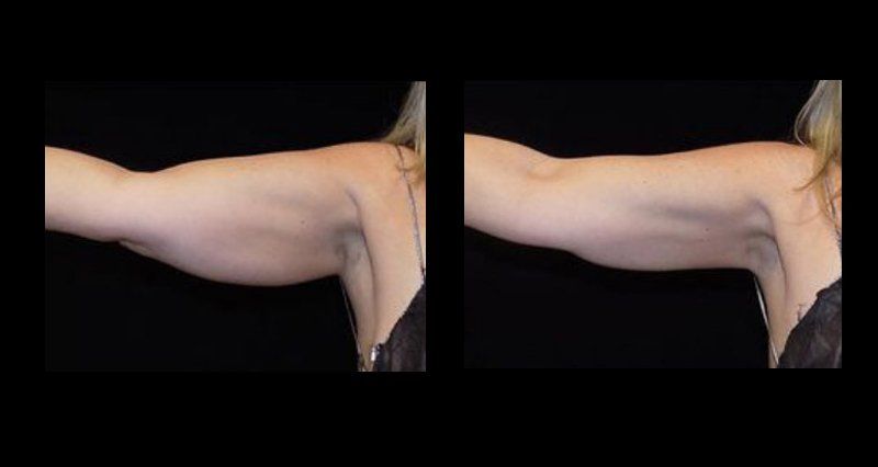 liposuction in mexico