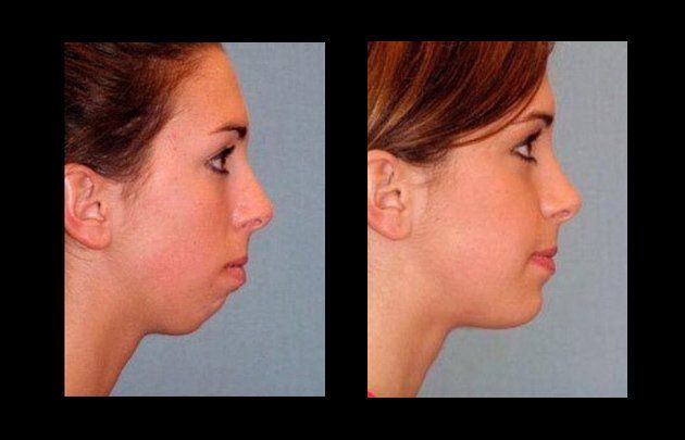 facial lipofilling in mexico