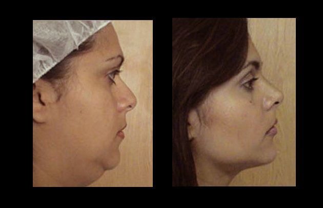 mentoplasty in mexico