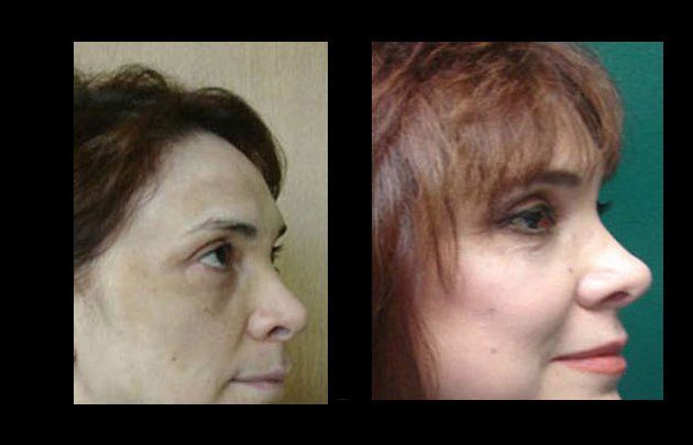 facial rejuvenation in mexico
