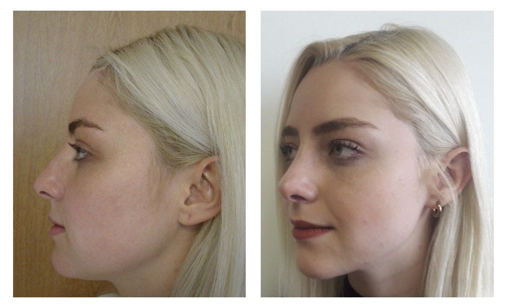 rhinoplasty in mexico